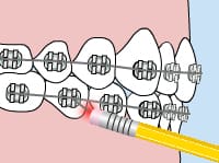 Teeth with braces being adjusted by a pencil eraser with a red force light, for Carpinello Orthodontics in Drexel Hill, Newtown Square or Edgmont, PA.
