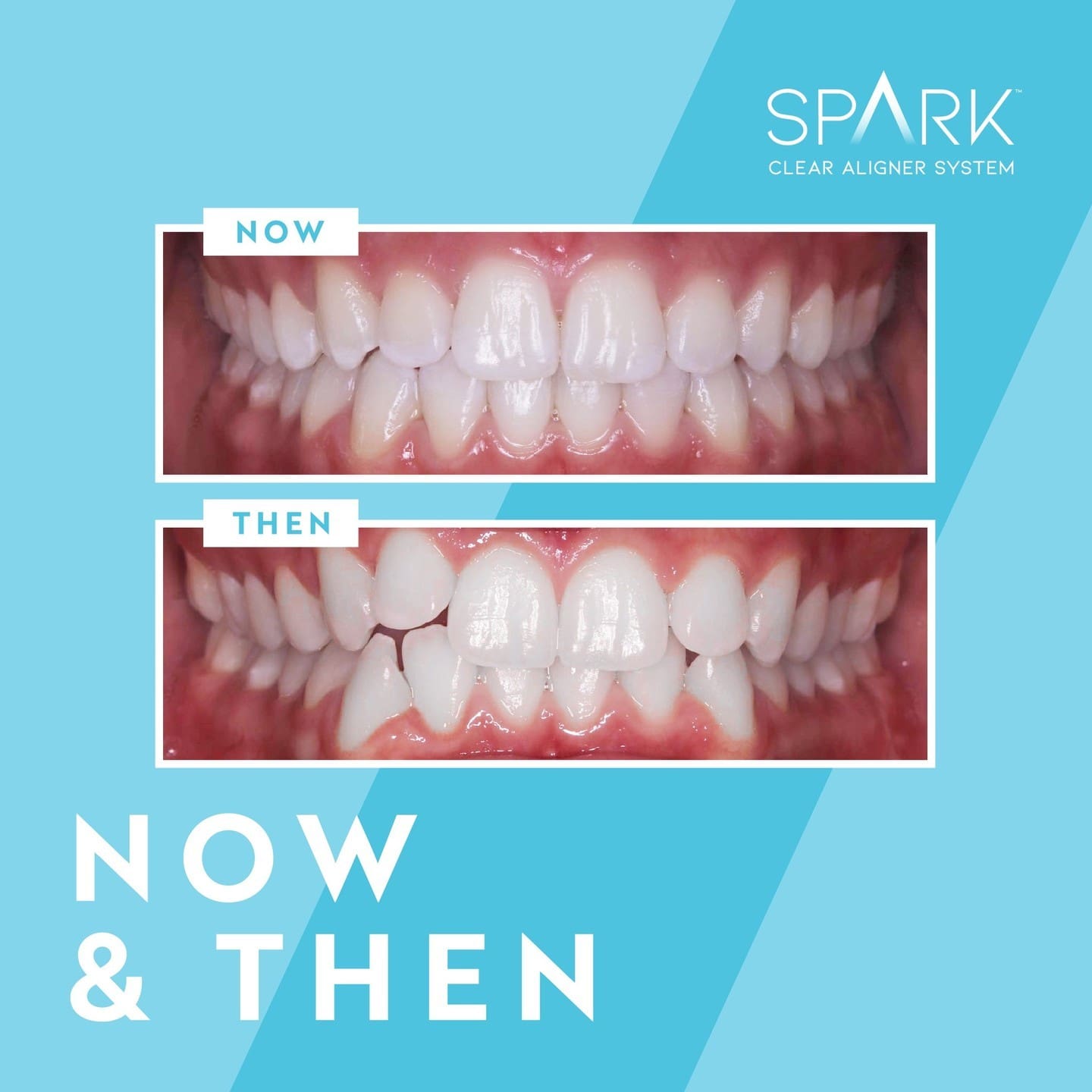 Before after dental treatment with SPARK Clear Aligner at Carpinello Orthodontics in Edgmont, PA.