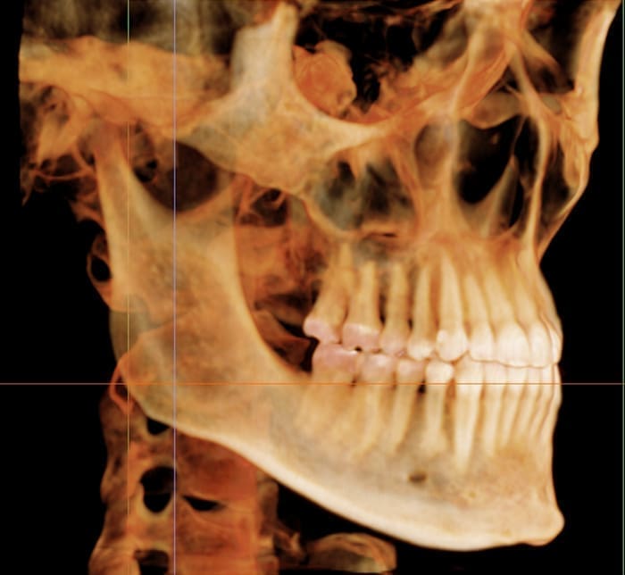 Dr. Paul Carpinello and Dr. David Carpinello: Orthodontist in Drexel Hill PA A 3D CT scan shows a skull’s side view with bone structure and teeth at Carpinello Orthodontics in Drexel Hill, Newtown Square or Edgmont, PA.